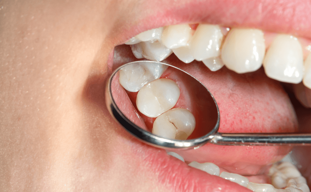 como saber si tienes caries