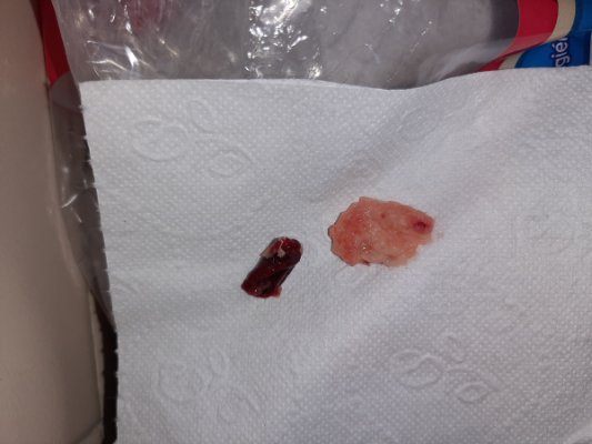 como saber si tuve un aborto completo